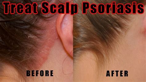 How To Treat Psoriasis Scalp Treat Natural Treating - BLOG HOWTOID