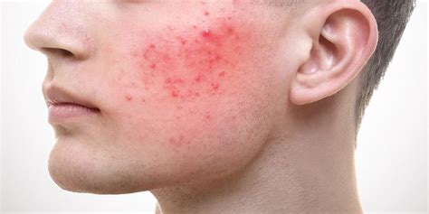 Know About Rosacea Skin Care - Outsidethewall