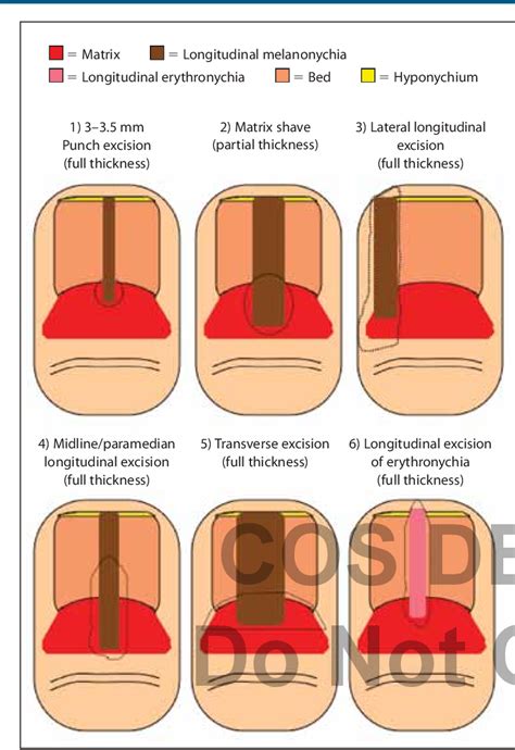 Figure 3 from Matrix Biopsy of Longitudinal Melanonychia and ...