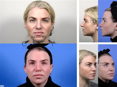 NYC Nasal Surgery (Rhinoplasty) Before and After Pictures - New York - UES