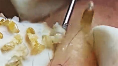 Cystic Acne Extraction This Week, Blackheads Removal, Blackhead ...