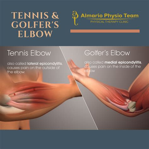 Tennis Elbow Symptoms Pictures