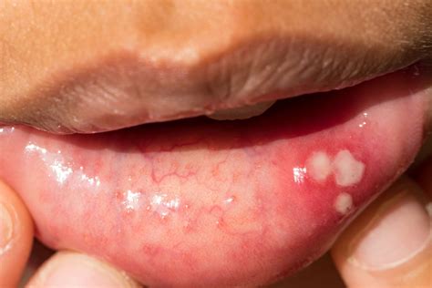 What Does Syphilis Look Like On Lips | Lipstutorial.org