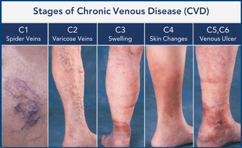 Venous Stasis Ulcer Stages