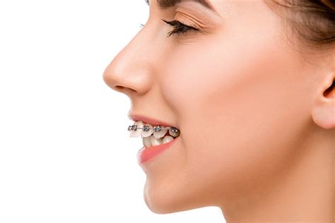 Orthodontist Treatment Options for an Overbite