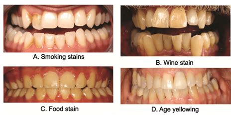 The Science Behind Teeth Whitening | Braddon Dental