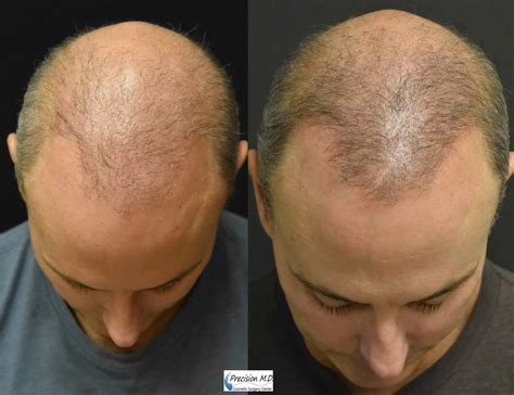 Before and After Hair Restoration showing the top of man's head