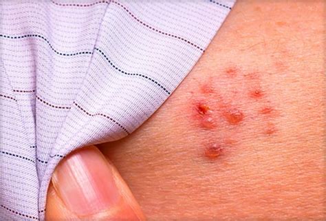 Seniors and Shingles: What You Need to Know — Calyx Health