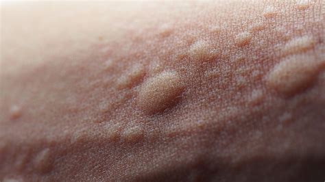 Hives Rash / 10 Serious Conditions That Rashes And Hives Can Indicate ...