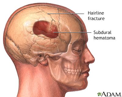 Compound Skull Fracture