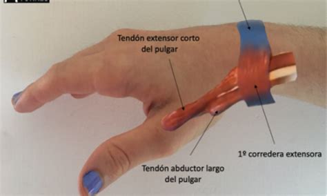 Fugaz animal Modernizar tendinitis dedo pulgar y muñeca Vigilante ...