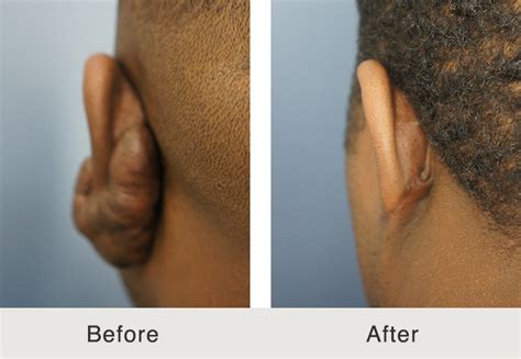 Keloid Removal and Treatments in Charlotte, North Carolina Facial Plastics