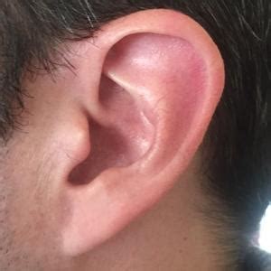 All about earlobes!: West End Facial Plastic Surgery: Facial Plastic ...