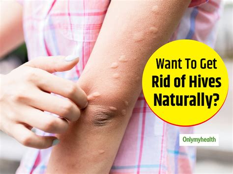 Irritated With Hives? Try These Effective Natural Remedies | OnlyMyHealth