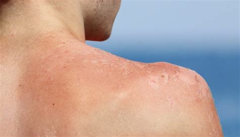 Sun Damage Treatment in Toronto - Compass Dermatology