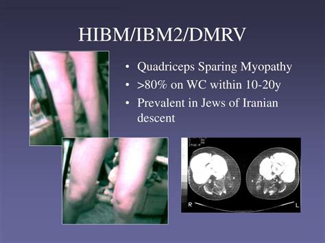 PPT - HIBM Hereditary Inclusion Body Myopathy PowerPoint Presentation ...