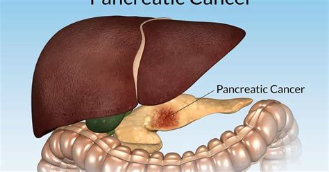 Stage 4 Pancreatic Cancer Prognosis - CancerOz