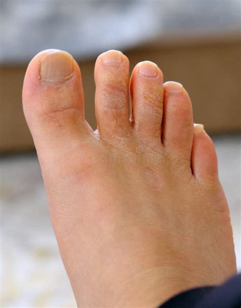 Fungal Disease on the Toes, Fungus Formation on the Toes, Human Foot ...