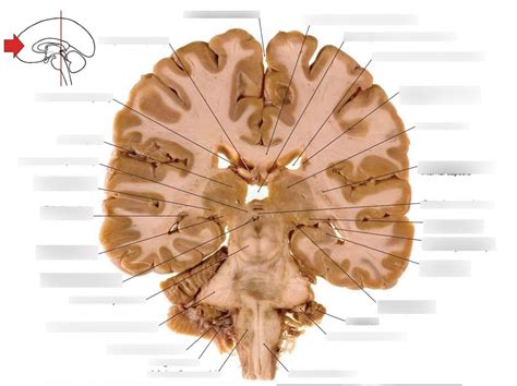 The rostral surface of a coronal section of brain through the pulvinar ...