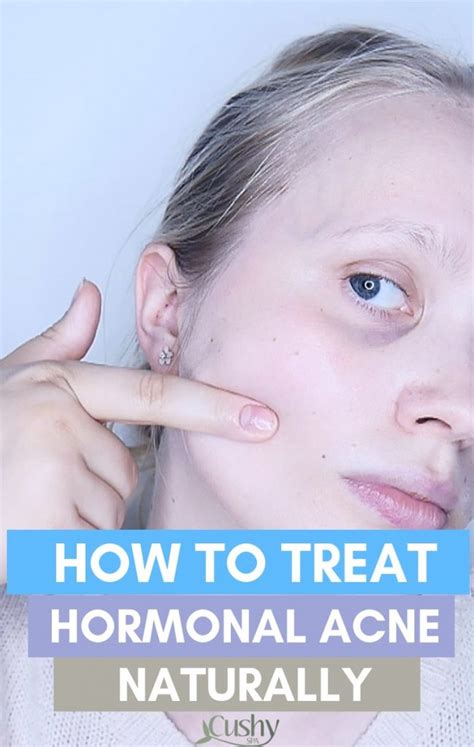 How to Treat Hormonal Acne Naturally: 8 Treatments - Cushy Spa