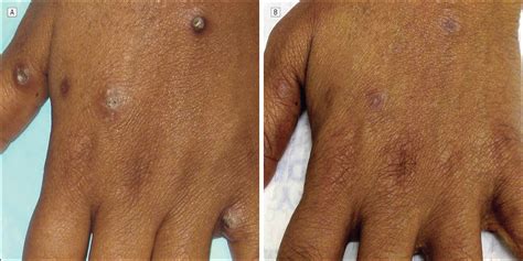 Treatment of Refractory Prurigo Nodularis With Lenalidomide ...