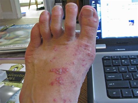 shingles on foot | Flickr - Photo Sharing!