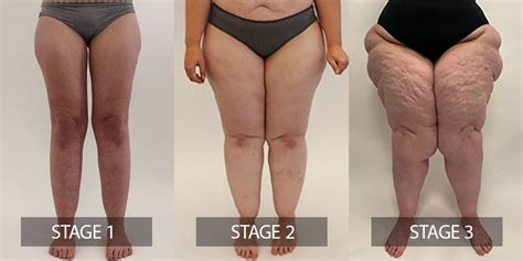 Different Stages And Types Of Lipedema - LipoClinic