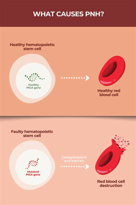 PNH Causes | PNH News