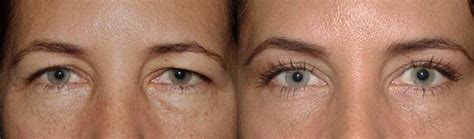 Brow lift with upper and lower blepharoplasty - Dr. Guy Massry