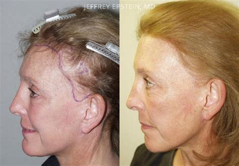 Facelift Scar Repair | Miami Repair Facelift Scarring | Hair Restoration