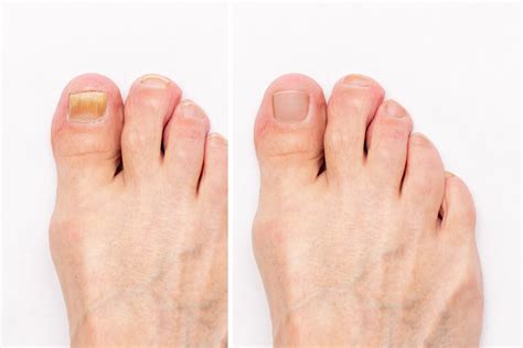 Kansas Toenail Fungus Experts - Community Foot Clinic of McPherson