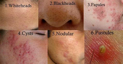 Types of Acne | Back acne treatment, Diy acne treatment, Cystic acne ...