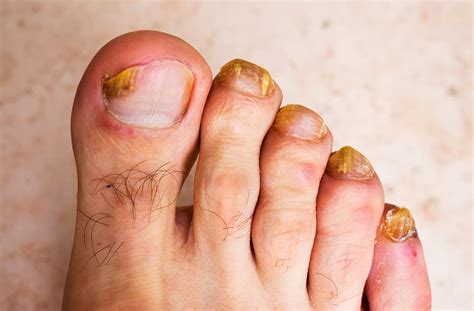 Brown Spot on the Toenail: Causes and Treatment – NailDesignCode