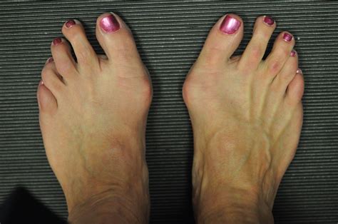 Bunions - OrthoInfo - AAOS