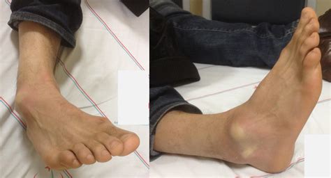 Subtalar dislocation | The Foot and Ankle Online Journal