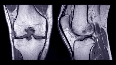 Bone Marrow Edema in the Knee: Causes, Symptoms, Treatment