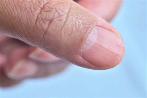 Ridges In Fingernails: Causes, Symptoms And Treatments