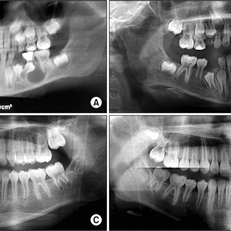 (PDF) Conservative management of a dentigerous cyst associated with ...