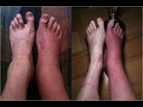 Bone Marrow Edema Treatment - Symptoms and Causes - Diagnosis ...