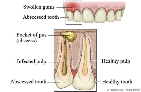 Dental abscess