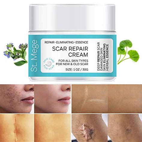 The 12 Best Scar Creams in 2021 - Top Picks & Buying Guide