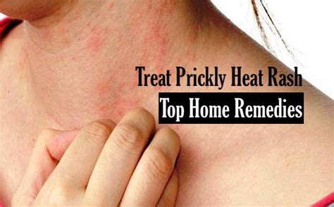 Fine Beautiful Info About How To Get Rid Of Heat Rash ...