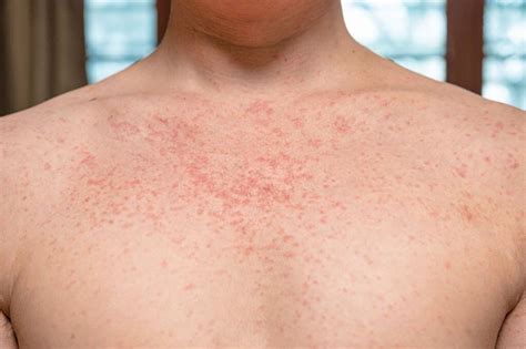 What are the Symptoms of Syphilis Rash and the Treatment for Syphilis ...