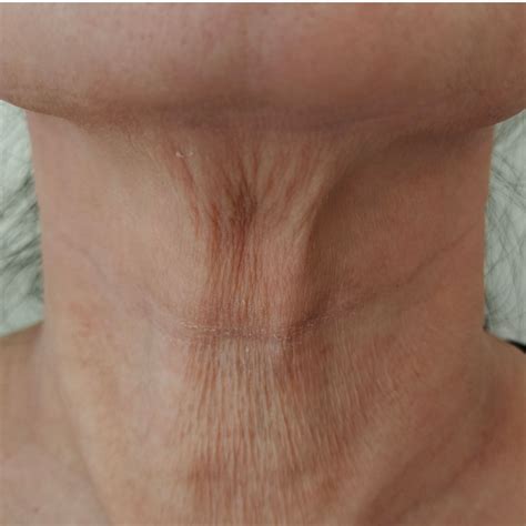 Discover Effective Turkey Neck Treatment Options in Brisbane