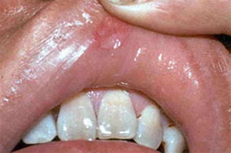 Pictures Of Syphilis Sores On The Lips | Lipstutorial.org