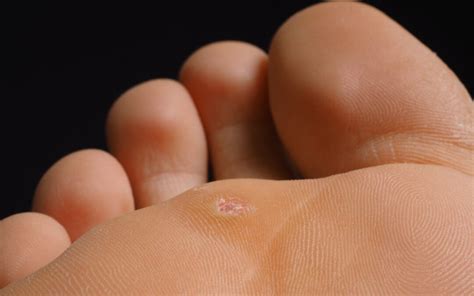 Plantar wart removal guide | Family Foot & Ankle Centers