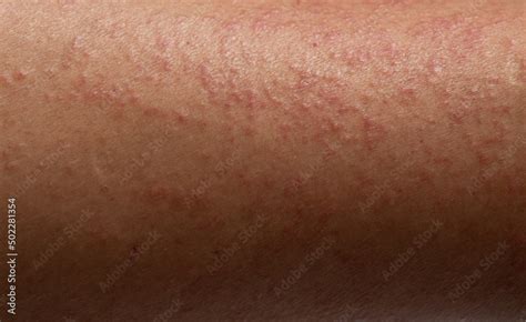 Strong allergic rashes on the leg , Dermatological rash on the skin and ...