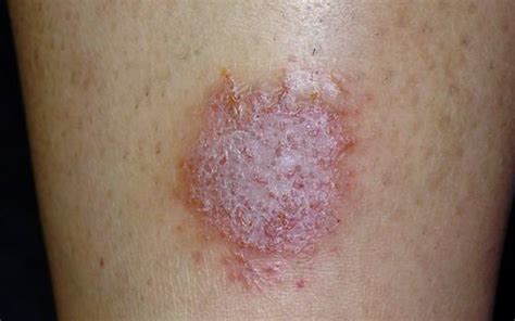 👉 Nummular Eczema - Pictures, Treatment, Causes, Symptoms, Diagnosis ...