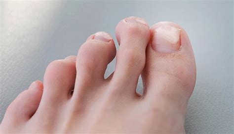 Onycholysis: Causes, Symptoms, And Treatments, 40% OFF