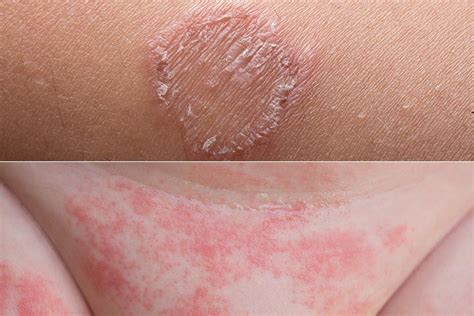 Fungal Rash On Inner Thigh